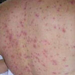 Salud reporta casi 6 mil confirmados de chikungunya en las tres primeras semanas del año